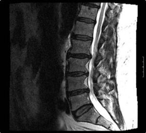 рентген на цервикалниот 'рбет со остеохондроза