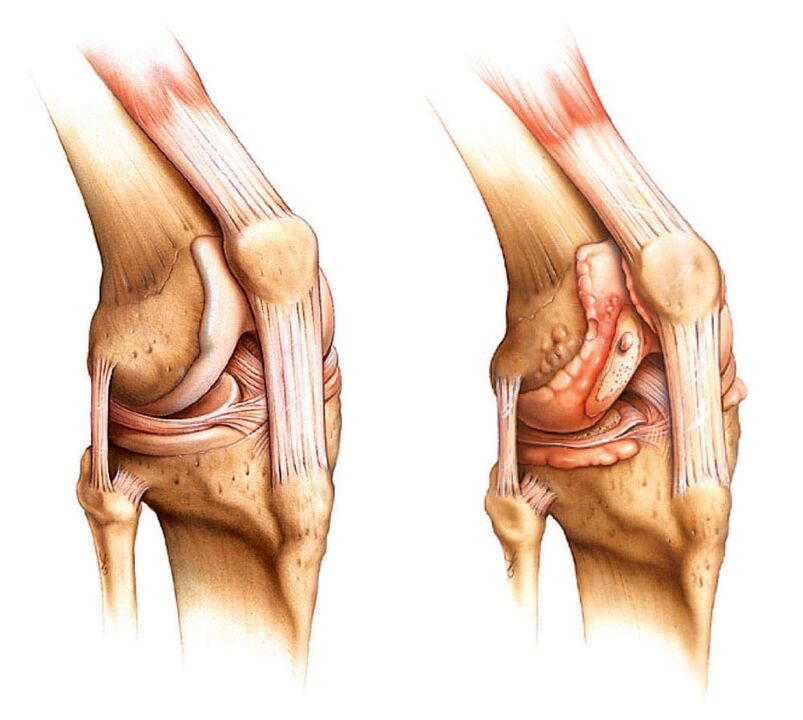 Здрав зглоб (лево) и артритичен зглоб (десно)