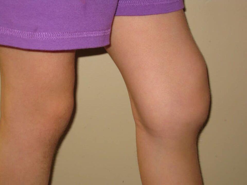 Патологија на коленото со напредна артроза