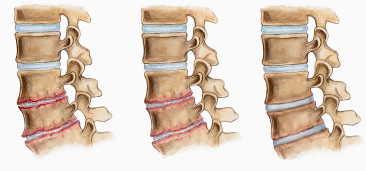 Деформацијата на интервертебралните дискови кај остеохондрозата може да предизвика болки во грбот