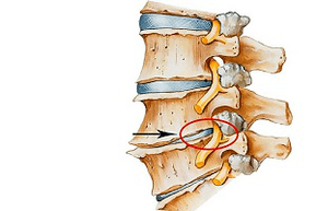 стиснат диск на 'рбетот како причина за цервикална остеохондроза